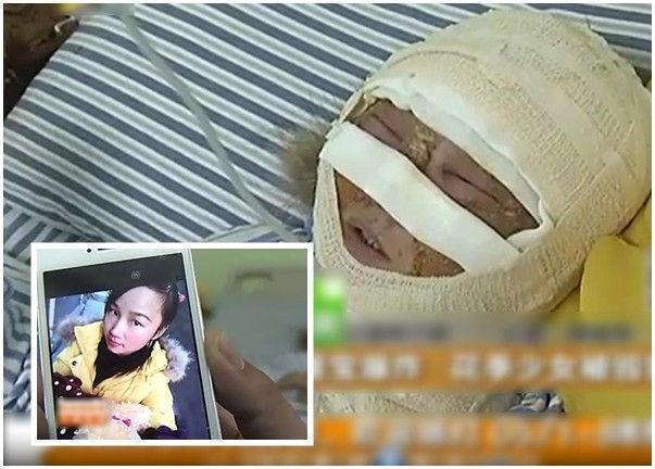 大陸電熱水袋安全成疑 突爆炸美女慘被燙傷恐毀容