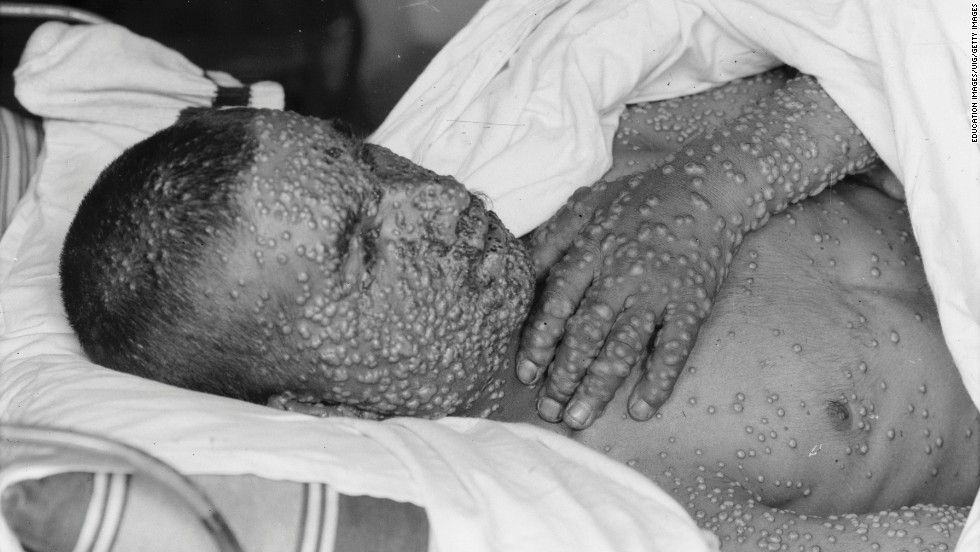 歷史上的世紀傳染病